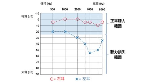 噪音符號|如何解讀聽力測試報告